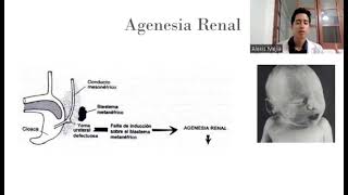 Agenesia Renal [upl. by Merry]