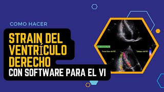 🏅STRAIN del VENTRICULO DERECHO con Software para el Ventrículo Izquierdo [upl. by Candless994]