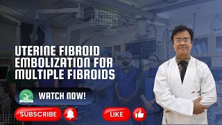 Uterine Fibroid Embolization for Multiple Fibroids  Dr Sandeep Sharma  IRFACILITIES [upl. by Artimid]