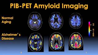 Early Detection and Prevention of Alzheimers Disease Video  Brigham and Womens Hospital [upl. by Ayalat]