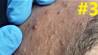 BLACKHEADS EXTRACTIONS on Happys Forehead 3 [upl. by Sueaddaht]