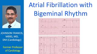 Atrial Fibrillation with Bigeminal Rhythm [upl. by Mode]