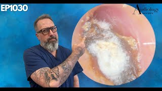 Deep Dry amp Difficult Furry Ear Wax Plug Removal  EP1030 [upl. by Sila623]