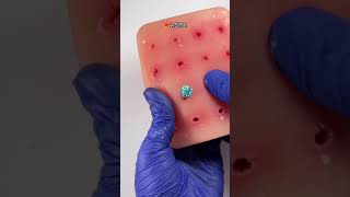 ASMR ear cleaning asmrsounds asmr blackdots asmrcosmetologist viral skincare acnetreatment [upl. by Sanferd232]