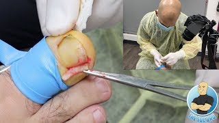 FIRST PERSON INGROWN TOENAIL REMOVAL [upl. by Wiltsey]