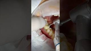 아래어금니 세멘리스 세팅과정 lower first molar single implant dentalclinic dentistry [upl. by Fesoj340]