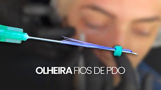 VEJA UM PREENCHIMENTO COM FIOS DE PDO PARA OLHEIRA [upl. by Maryl]