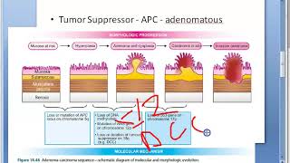 Pathology 521 h AdenoCarcinoma Colon sequence colorectal cancer tumor mutation DCC genetics [upl. by Anatola968]