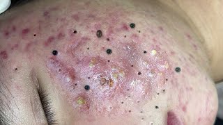 Big Cystic Acne Blackheads Extraction Blackheads amp Milia Whiteheads Removal Pimple Popping  8993 [upl. by Leirbma]