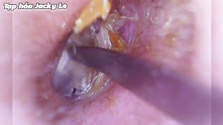 Ear Wax Removal 179 The ear canal is very narrow and small  Ear Cleaning ASMR [upl. by Eoin]