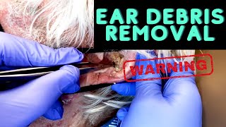 INSANE Ear Debris Debulking  CONTOUR DERMATOLOGY [upl. by Boorman424]