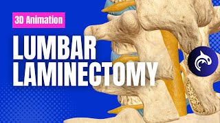 Lumbar Laminectomy  3D Animation [upl. by Lledraw]