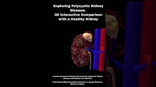 3D Polycystic Kidney Disease Comparison renal polycystickidneydisease kidneys nephrology [upl. by Qifar]