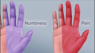 phalens test for carpal tunnel syndrome شرح بالعربي [upl. by Ailuig]