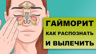 ГАЙМОРИТ СИНУСИТЫ Как диагностировать и лечить [upl. by Koralle]