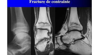 Imagerie médicale en pathologie sportive de l’enfant et de l’adolescent [upl. by Isolde]