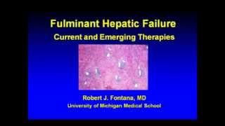 Fulminant Hepatic Failure Current and Emerging Therapies [upl. by Bisset]