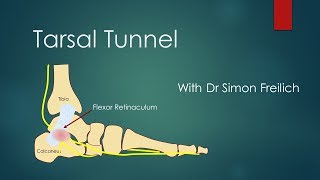 Tarsal Tunnel Syndrome [upl. by Mcleroy]