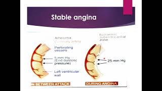 PATHOPHYSIOLOGY OF ANGINA [upl. by Dolloff509]