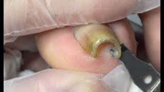 A Perfect nail cutting for super curved nail  Best Nail Skill Teaching by Mr Toenail [upl. by Ahsenrad]