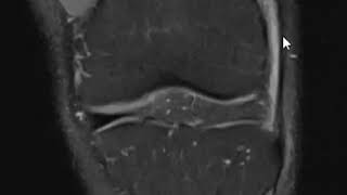 Iliotibial band ITB friction syndrome and chondral shear injury of the patella [upl. by Alexis]