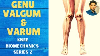 GENU VALGUM amp GENU VARUM  Knee Complex Biomechanics [upl. by Murvyn]