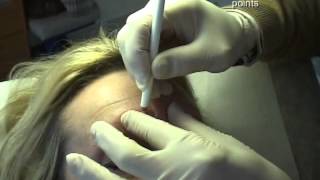 procedure Toxine botuliqueinjection de botox [upl. by Ib929]