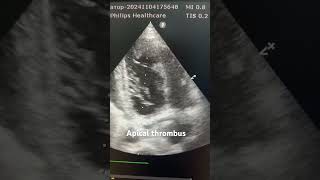 Apical thrombus echocardiography cardiacimaging cardiology [upl. by Gleda]