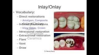 Introduction to inlaysonlays [upl. by Yar]