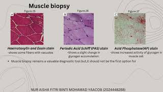 POMPE DISEASE [upl. by Naves]