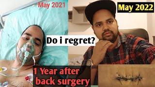 1 Year after back surgery and big lessons for life L4L5S1 recovery after microdiscectomy mustwatch [upl. by Ylsel]