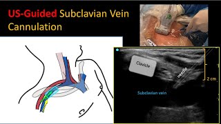 Ultrasoundguided subclavian vein cannulation – How I Do It [upl. by Atinrehs]