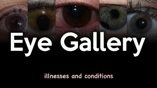 Eye Illnesses and Conditions Image Gallery [upl. by Nyladnar]