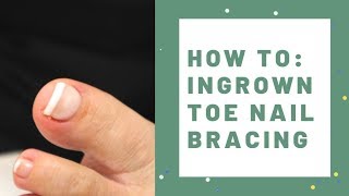 LCN Ingrown Toe Nail Bracing [upl. by Che]