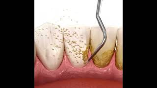 Scaling teeth using Ultrasonic Scaler [upl. by Akehs]