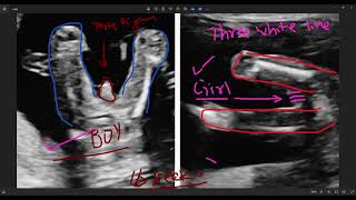 12 week ultrasound  sonography se kaise jane ladka hai ya ladki  6 week ultrasound  trimester [upl. by Eveiveneg]