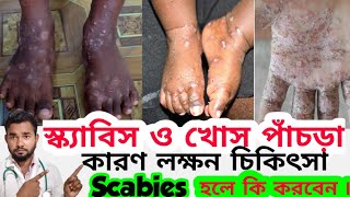 স্ক্যাবিস ও খােস পাঁচড়ার কারণ লক্ষন চিকিৎসা Scabies Treatment Banglacpdrubelmia5966 খােস পাঁচড়া [upl. by Erodoeht]