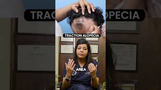 Traction Alopecia  Hair Transplant Clinic  Dadu Medical Centre [upl. by Roanna22]