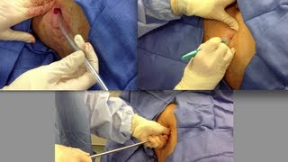 Chest Tube Placement [upl. by Emelyne]