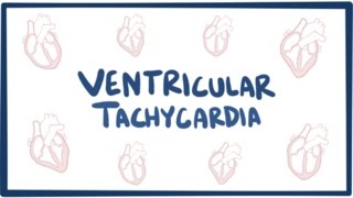 Ventricular tachycardia VT  causes symptoms diagnosis treatment amp pathology [upl. by Centonze155]