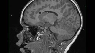 Tuberous Sclerosis with Subependymal Giant Cell Astrocytoma [upl. by Ener544]