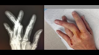 dislocated fingers [upl. by Acceb]