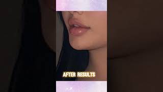 Lip Filler Treatment results in BandraMumbai [upl. by Soigroeg]