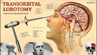 The TERRIFIC History of Lobotomy [upl. by Litta]