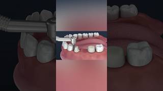 Tooth supported fixed bridge of 3 teeth medicalanimation health dentist [upl. by Surbeck570]