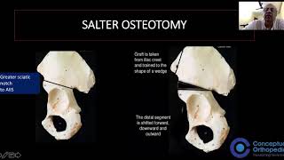 Pediatric Orthopaedics  Pelvic Osteotomies by Legendary Orthopedician ProfDrGopa Kumar TS [upl. by Ardenia]