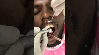 உடைந்த பல் சரி செய்தல்  Fixing broken teeth Dr Dinesh Kowsky [upl. by Notrom]