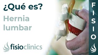 ¿Qué es una hernia discal lumbar y cuáles son sus síntomas y causas  FisioClinics Palma [upl. by Kirven]