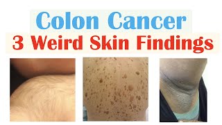 3 Weird Signs of Colon Cancer Found on the Skin [upl. by Ayouqat598]