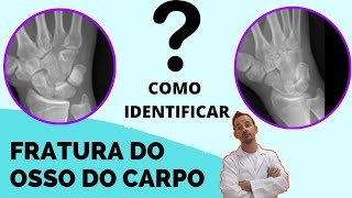 Como identificar uma fratura nos ossos punho  Medicina Geral [upl. by Aubert]